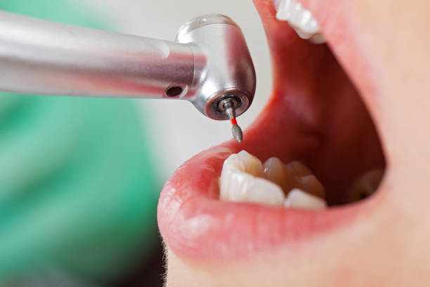 Best Emergency Dentist for Knocked-Out Tooth in Rollingwood, CA